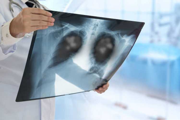 Lung Xray